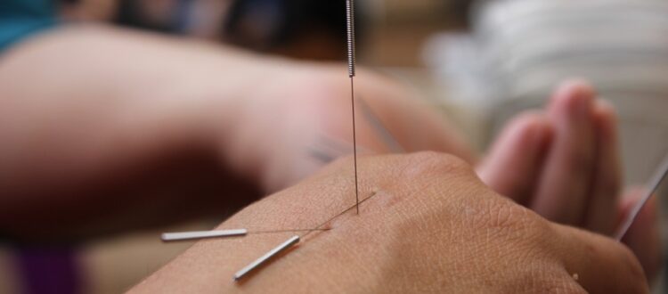Acupuncture needles positioned on top of a hand