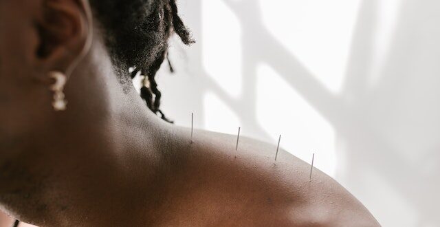 Person with four acupuncture needles inserted in shoulder
