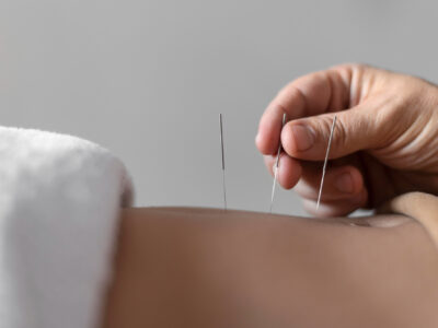 a person receiving acupuncture treatment