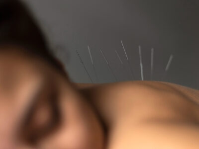 A Person Receiving Acupuncture Treatment