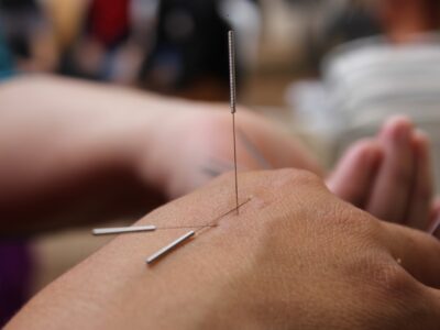 three acupuncture needles